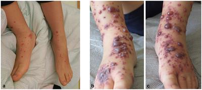 Hemorrhagic Bullous Henoch-Schönlein Purpura: Case Report and Review of the Literature